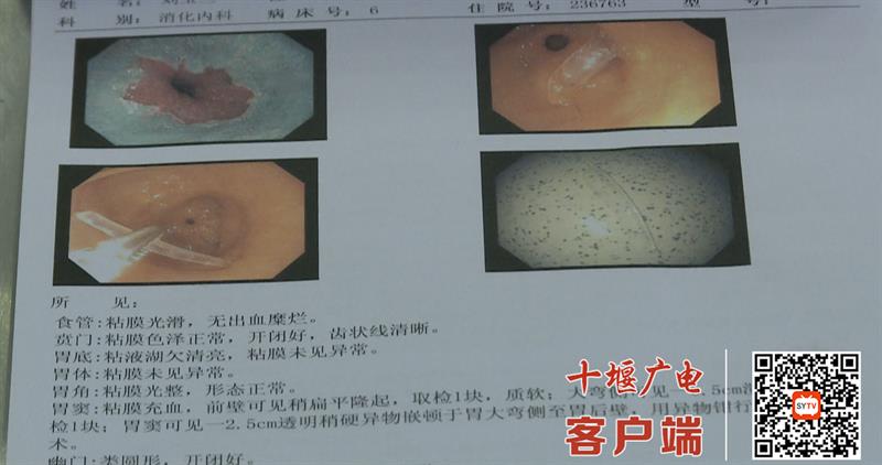 感觉胃里卡了个东西：是什么原因？