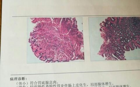 肠化十号是什么意思？